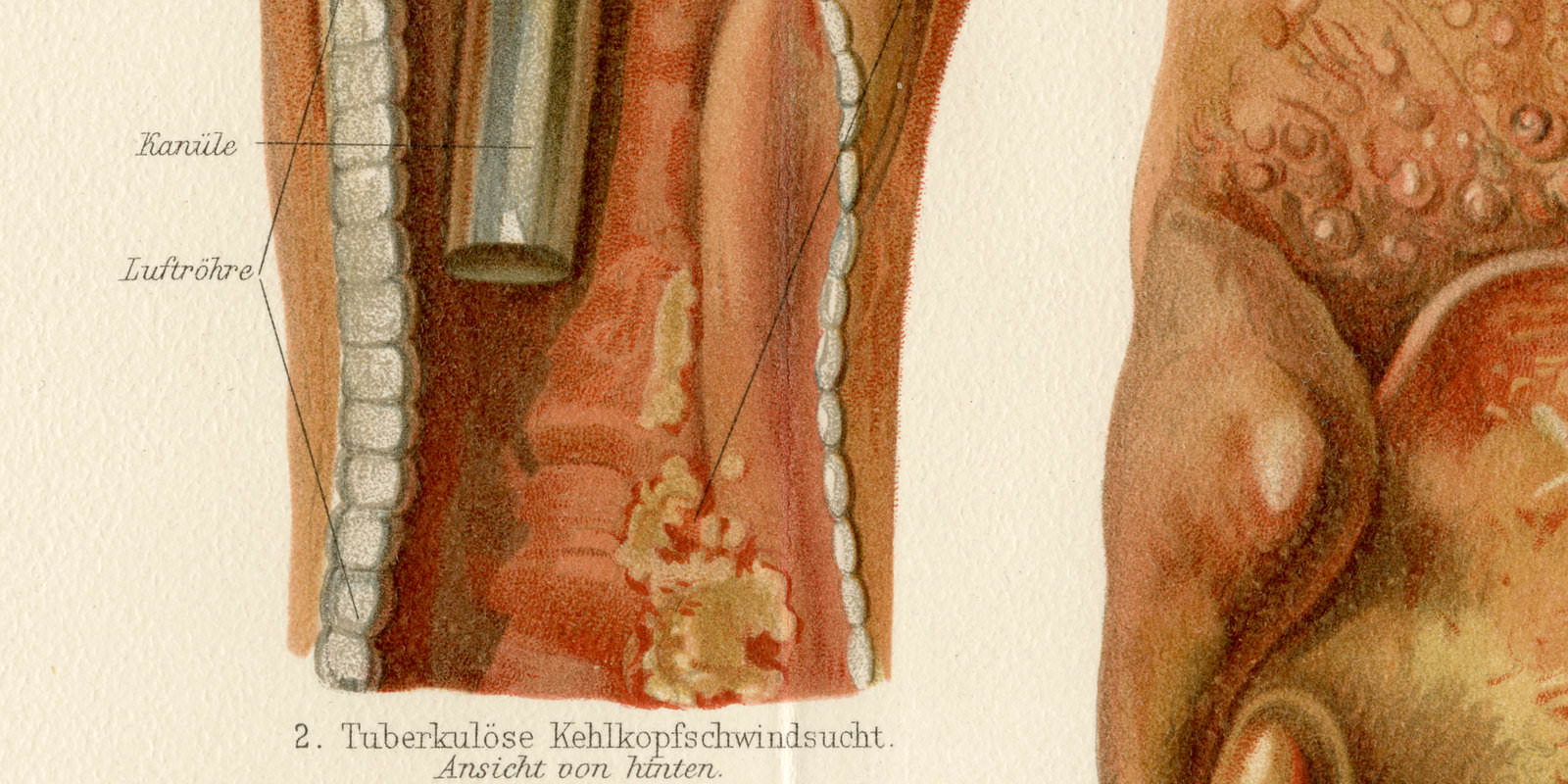 Halskrankheiten ca 1895 historische Bildtafel Chromolithographie