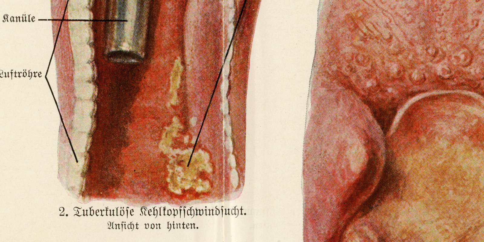 Halskrankheiten ca 1933 historische Bildtafel Chromotypie