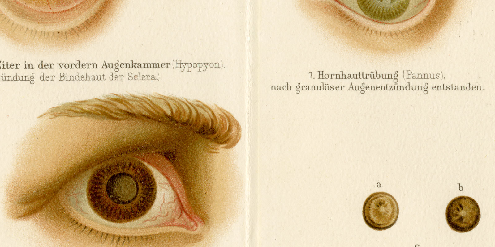Augenkrankheiten ca 1893 historische Bildtafel Chromolithographie