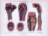 Chromolitographie aus 1893 zeigt Halskrankheiten in...