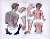 Chromolithographie aus 1893 zeigt verschiedene Hautkrankheiten in medizinischer Darstellung.